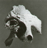 dislocatedhip_sb.jpg (17913 bytes)