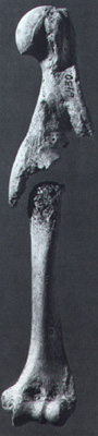 pseuduarthrosis_notset.jpg (19834 bytes)